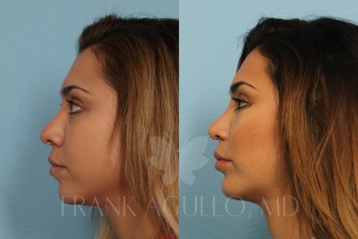Rhinoplasty Before and After 3