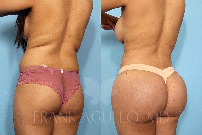 Brazilian Butt Lift Before and After 2