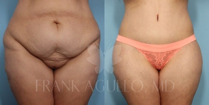 Tummy Tuck Before and After 18