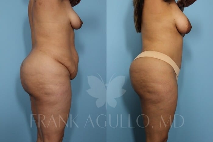 Tummy Tuck Before and After 2