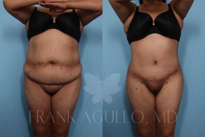 Tummy Tuck Before and After 16