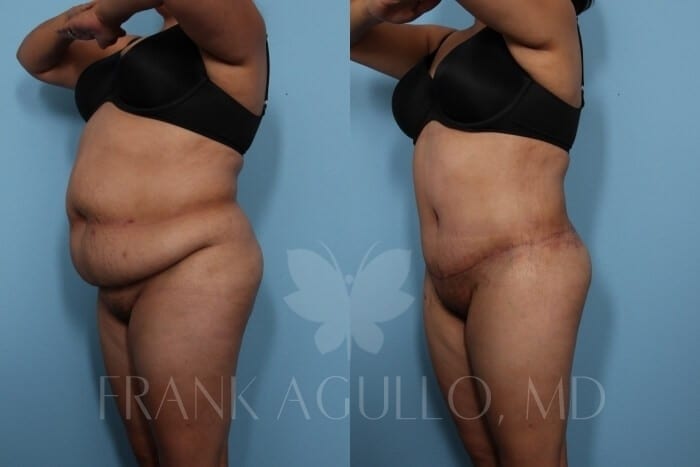 Tummy Tuck Before and After 2
