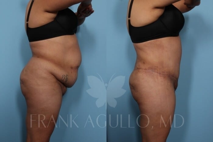 Tummy Tuck Before and After 3