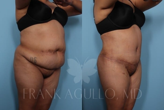 Tummy Tuck Before and After 4