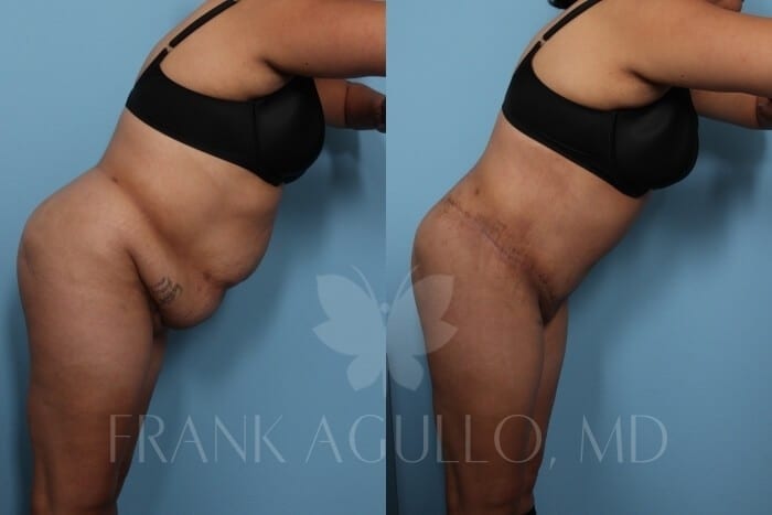 Tummy Tuck Before and After 5