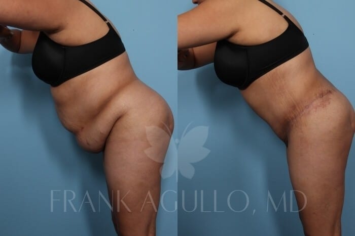 Tummy Tuck Before and After 6