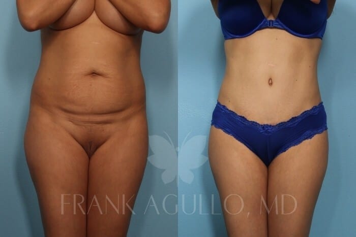 Tummy Tuck Before and After 15