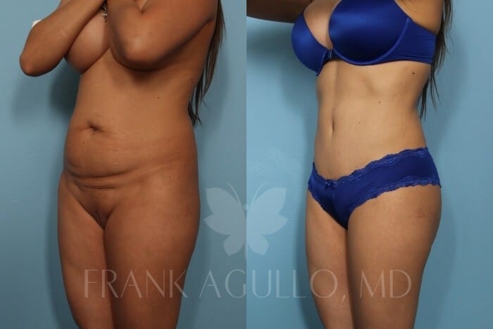 Tummy Tuck Before and After 2