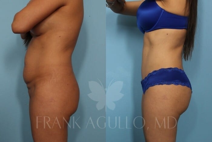 Tummy Tuck Before and After 3