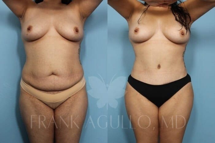 Tummy Tuck Before and After 13