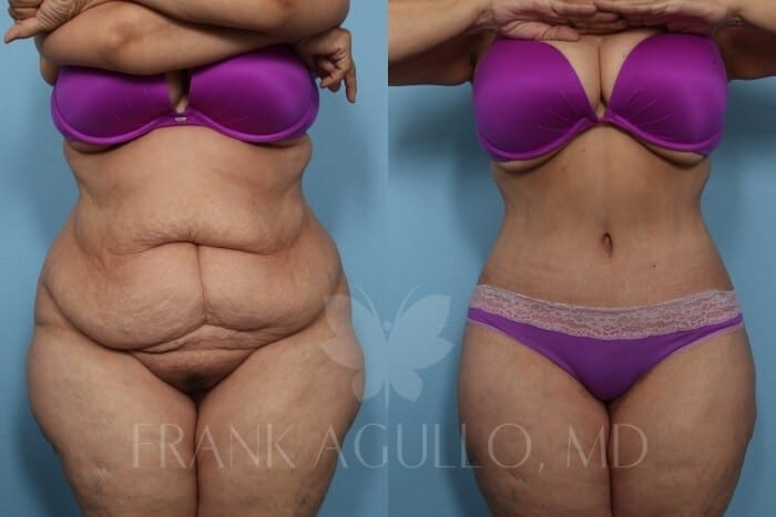 Tummy Tuck Before and After 1