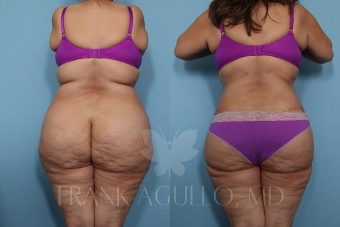 Tummy Tuck Before and After 2