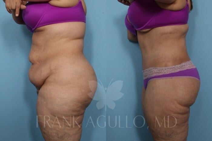Tummy Tuck Before and After 4