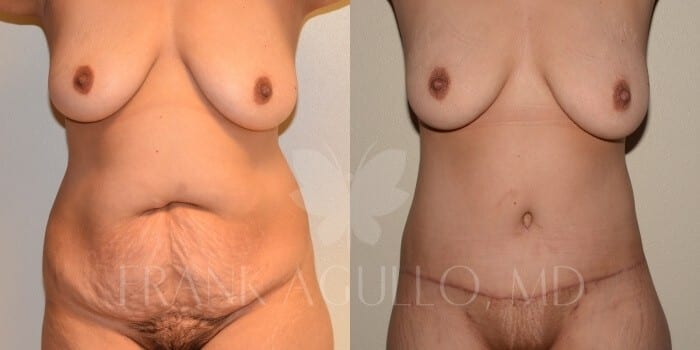 Tummy Tuck Before and After 20