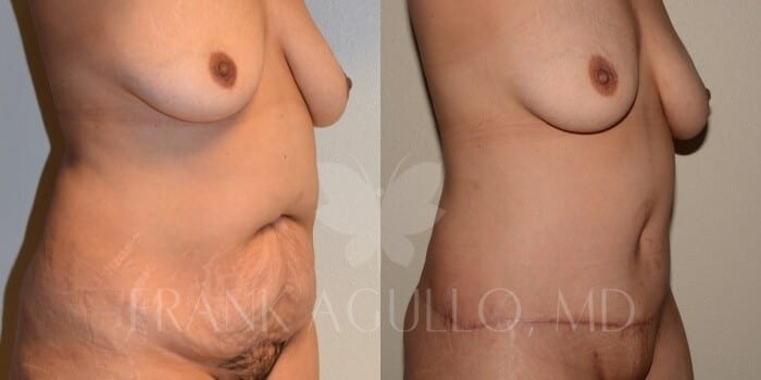 Tummy Tuck Before and After 3