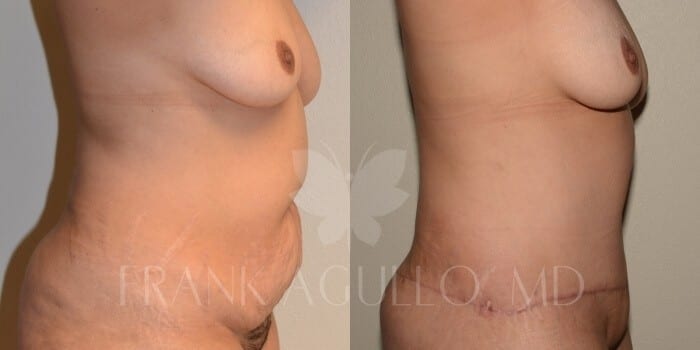 Tummy Tuck Before and After 4