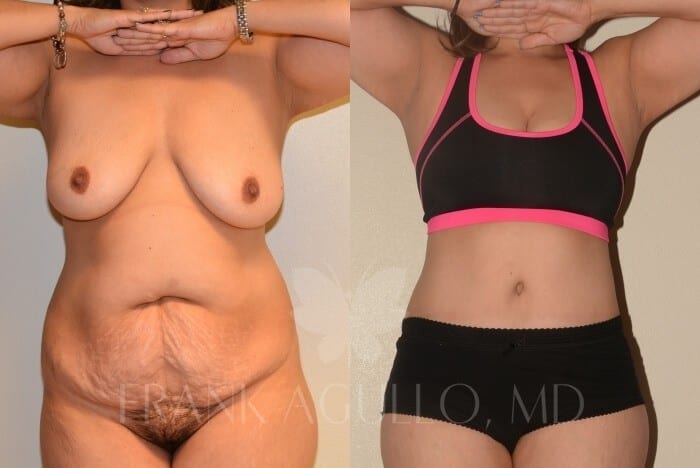 Tummy Tuck Before and After 5