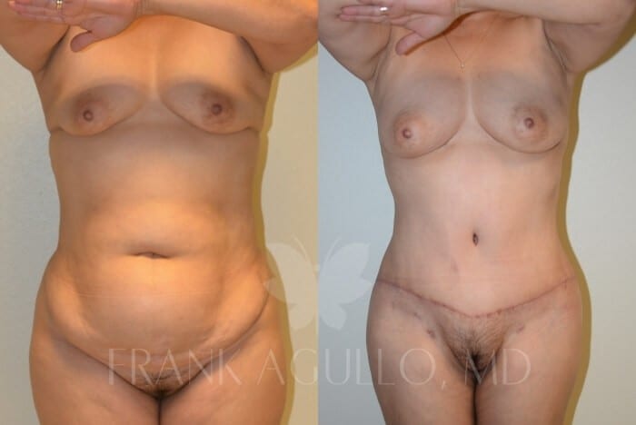 Tummy Tuck Before and After 19