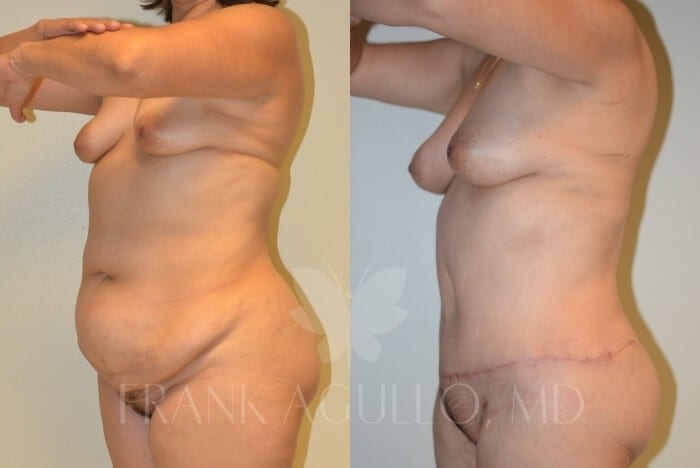 Tummy Tuck Before and After 2