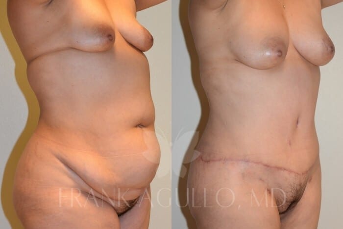 Tummy Tuck Before and After 3