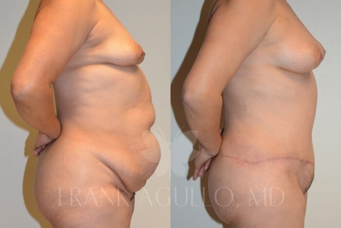 Tummy Tuck Before and After 4