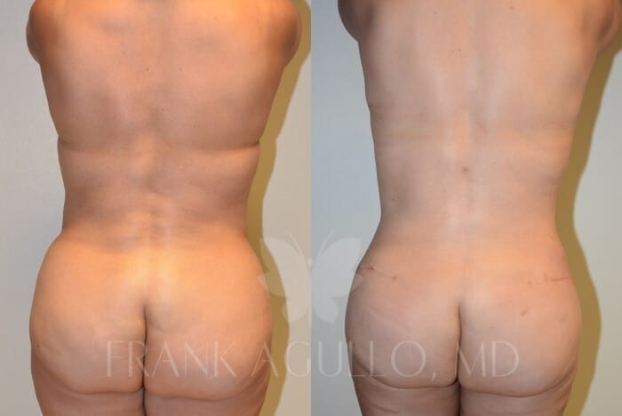 Tummy Tuck Before and After 5