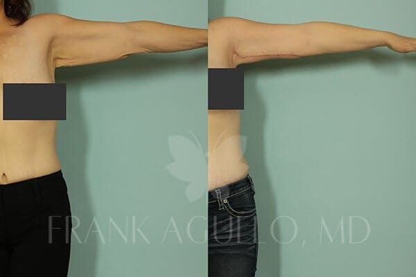 Arm Lift Before and After 2
