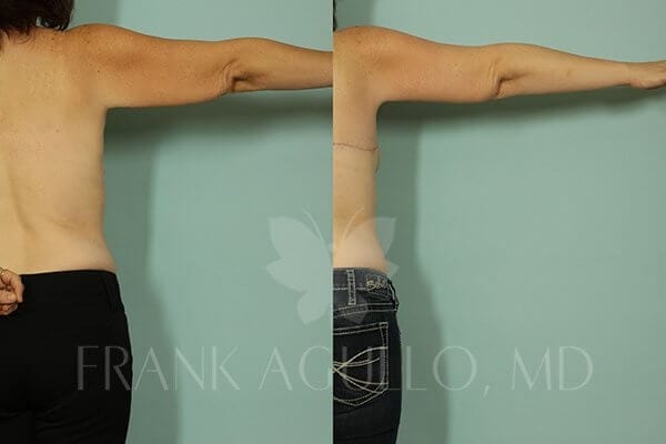 Arm Lift Before and After 3