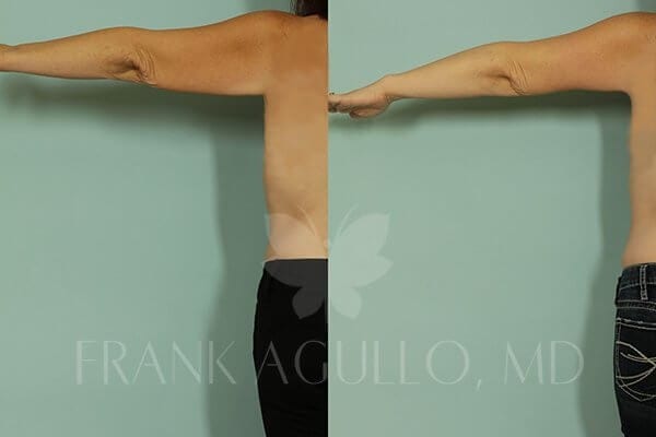Arm Lift Before and After 4