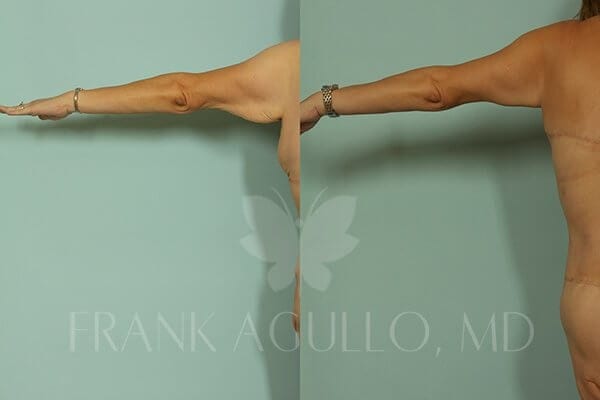 Arm Lift Before and After 4
