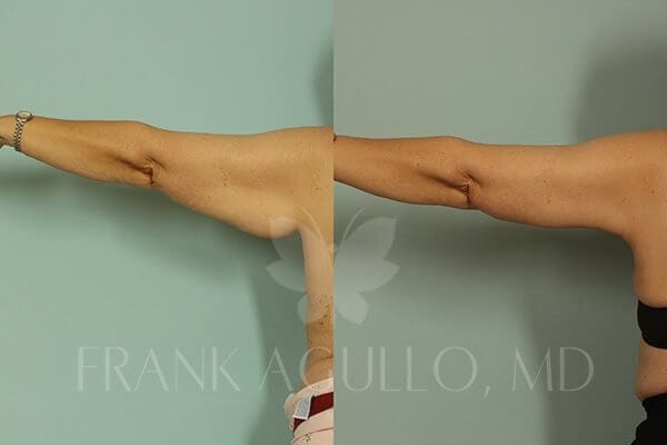 Arm Lift Before and After 3