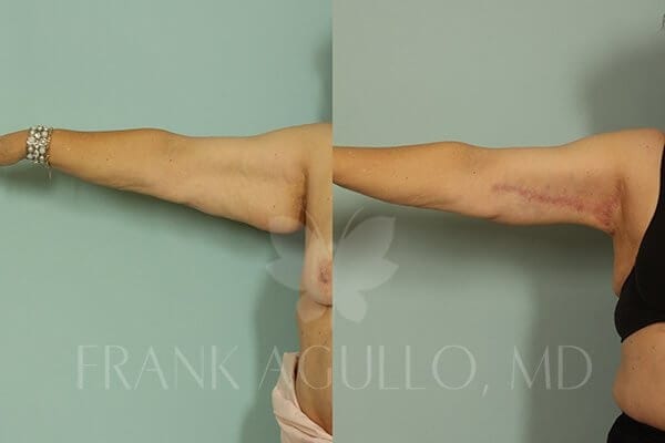 Arm Lift Before and After 4