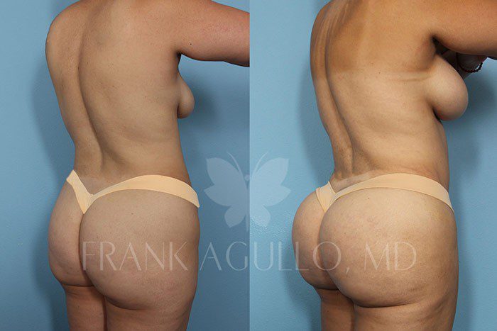 Brazilian Butt Lift Before and After 6