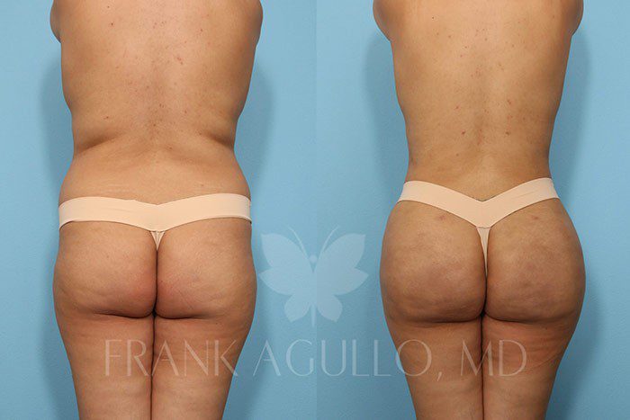 Brazilian Butt Lift Before and After 13