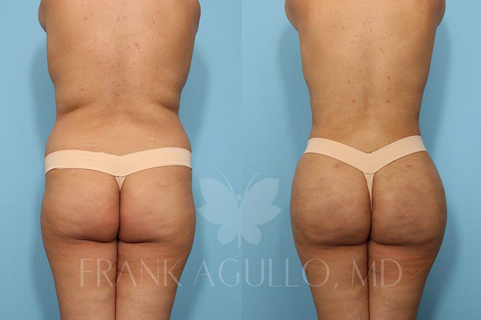 Brazilian Butt Lift Before and After 4