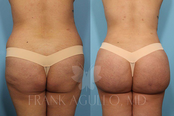 Brazilian Butt Lift Before and After 3