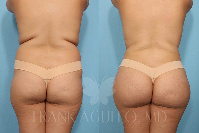 Brazilian Butt Lift Before and After 2