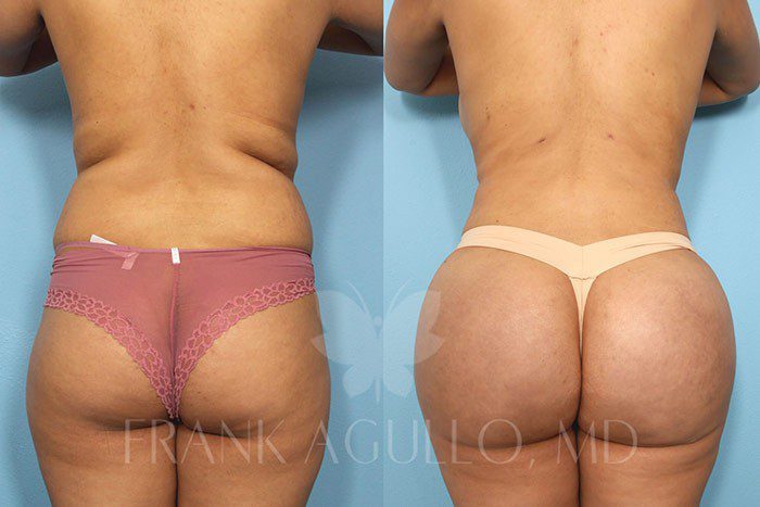 Brazilian Butt Lift Before and After 1