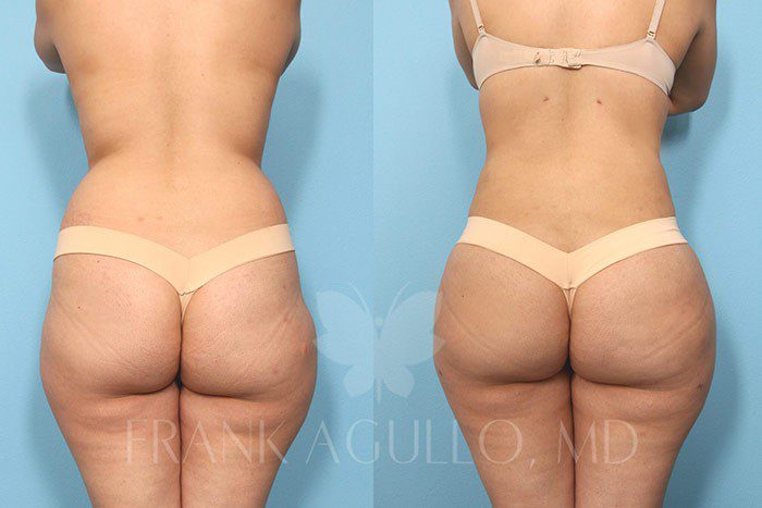 Brazilian Butt Lift Before and After 20