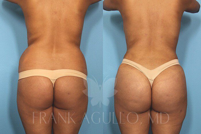 Brazilian Butt Lift Before and After 6