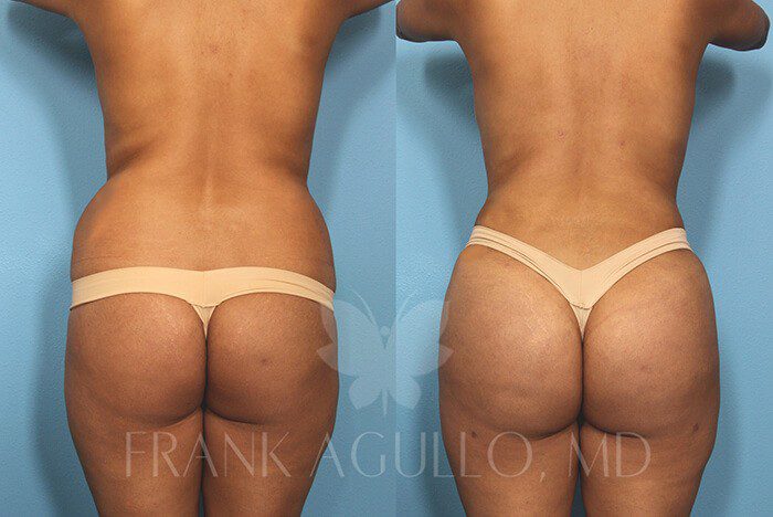 Brazilian Butt Lift Before and After 15