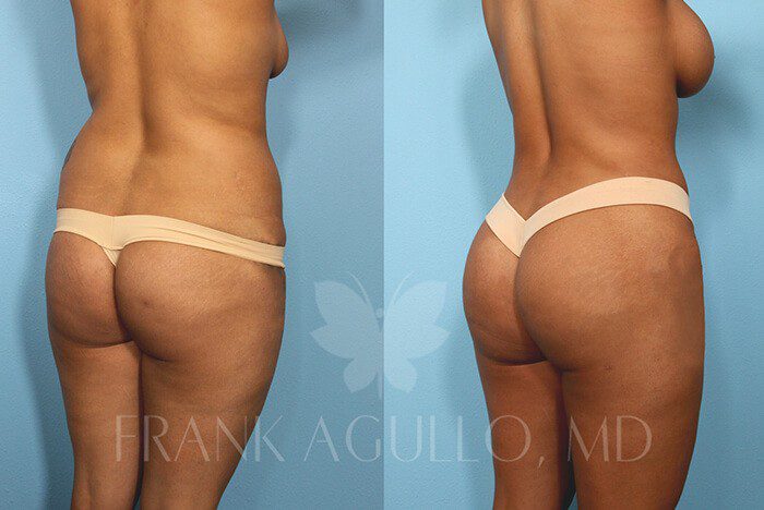 Brazilian Butt Lift Before and After 2