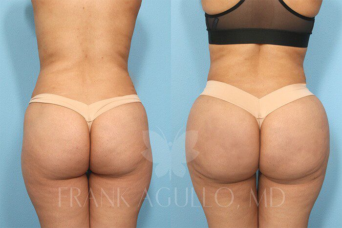 Brazilian Butt Lift Before and After 14