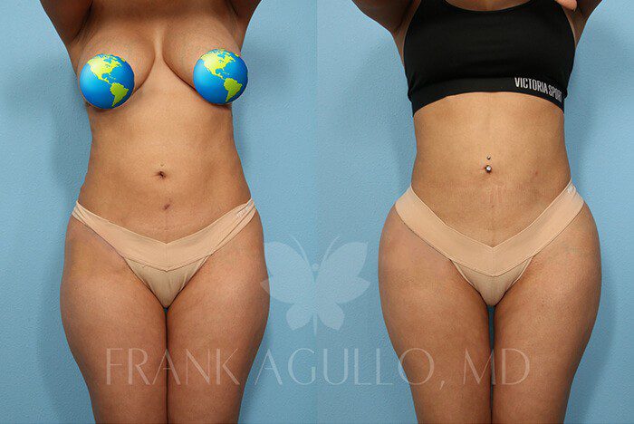 Brazilian Butt Lift Before and After 2