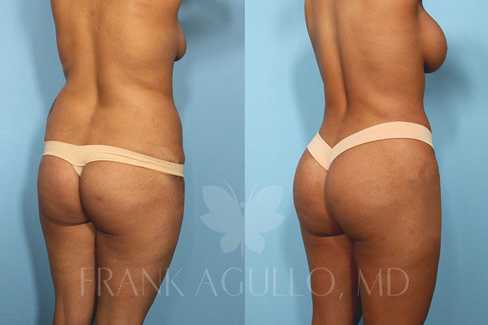 Brazilian Butt Lift Before and After 7