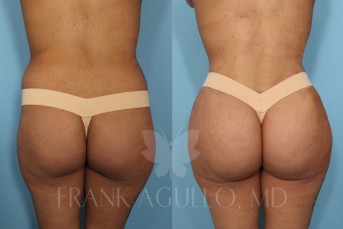 Brazilian Butt Lift Before and After 4