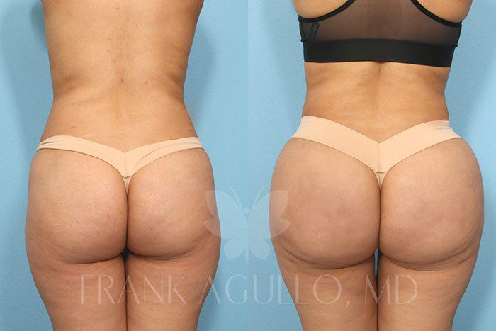 Brazilian Butt Lift Before and After 6