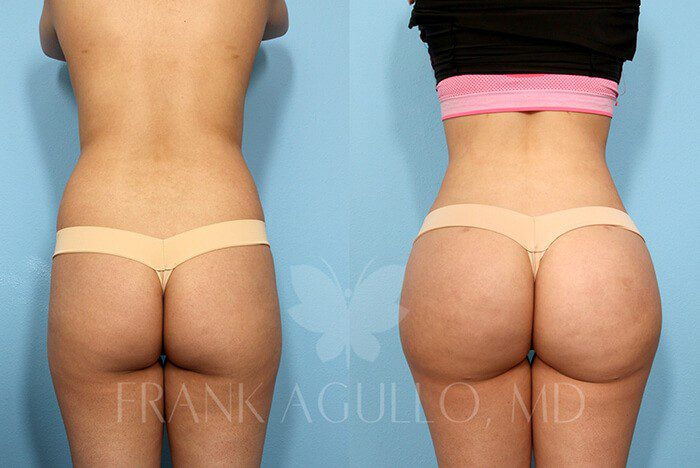 Brazilian Butt Lift Before and After 11
