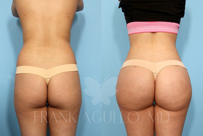 Brazilian Butt Lift Before and After 2