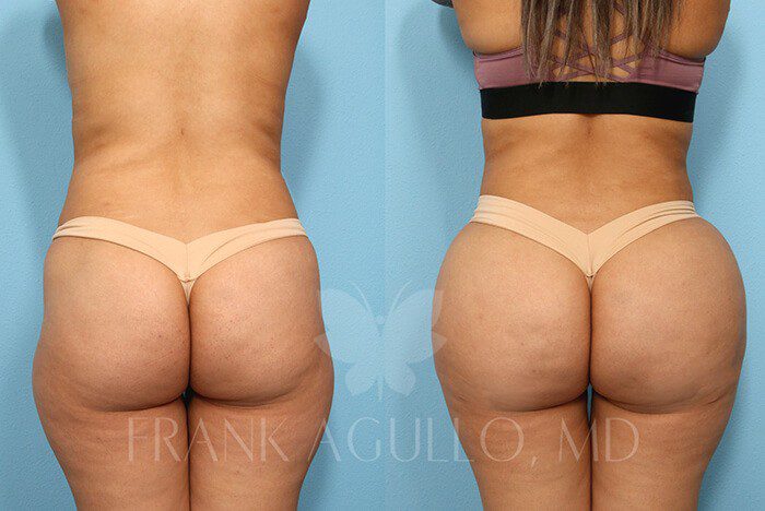 Brazilian Butt Lift Before and After 19